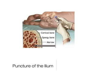 Puncture of the Ilium
 