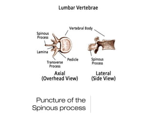 Puncture of the
Spinous process
 
