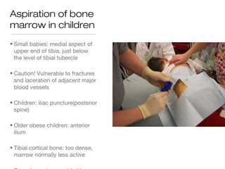 Aspiration of bone
marrow in children
• Small babies: medial aspect of
upper end of tibia, just below
the level of tibial tubercle
• Caution! Vulnerable to fractures
and laceration of adjacent major
blood vessels
• Children: iliac puncture(posterior
spine)
• Older obese children: anterior
ilium
• Tibial cortical bone: too dense,
marrow normally less active
 