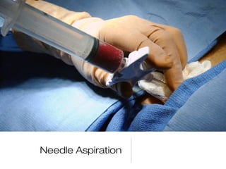 Needle Aspiration
 