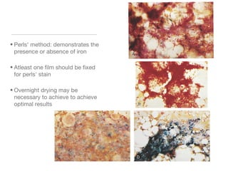 • Perls' method: demonstrates the
presence or absence of iron
• Atleast one film should be fixed
for perls' stain
• Overnight drying may be
necessary to achieve to achieve
optimal results
 