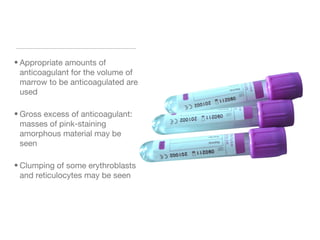 • Appropriate amounts of
anticoagulant for the volume of
marrow to be anticoagulated are
used
• Gross excess of anticoagulant:
masses of pink-staining
amorphous material may be
seen
• Clumping of some erythroblasts
and reticulocytes may be seen
 