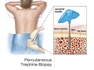 Percutaneous
Trephine Biopsy
 