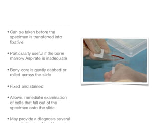 • Can be taken before the
specimen is transferred into
fixative
• Particularly useful if the bone
marrow Aspirate is inadequate
• Bony core is gently dabbed or
rolled across the slide
• Fixed and stained
• Allows immediate examination
of cells that fall out of the
specimen onto the slide
• May provide a diagnosis several
 