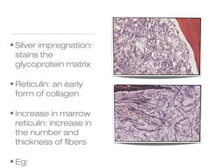 • Silver impregnation:
stains the
glycoprotein matrix
• Reticulin: an early
form of collagen
• Increase in marrow
reticulin: increase in
the number and
thickness of fibers
• Eg:
 