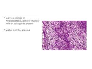 • In myelofibrosis or
myelosclerosis, a more "mature"
form of collagen is present
• Visible on H&E staining
 