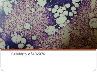 Bone marrow biopsy | PPTX