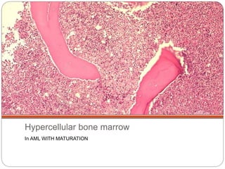 Bone marrow biopsy | PPTX