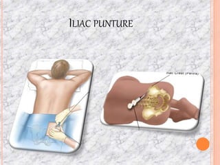 ILIAC PUNTURE
 