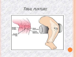 TIBIAL PUNTURE
 