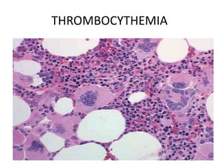 THROMBOCYTHEMIA
 