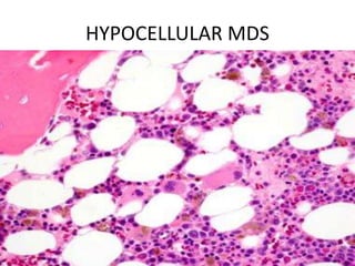 HYPOCELLULAR MDS
 