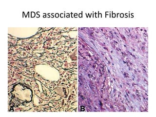 MDS associated with Fibrosis
 
