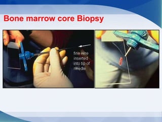 Bone marrow core Biopsy
 