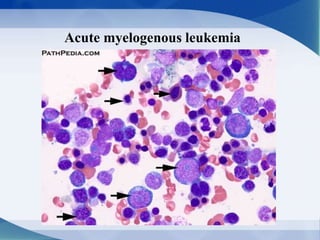 Acute myelogenous leukemia
 