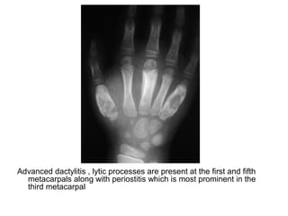 Diagnositc Imaging of Bone Marrow Disease | PPT