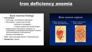 Iron deficiency anemia
 