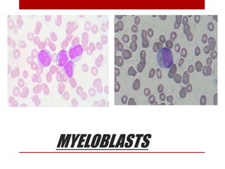 MYELOBLASTS
 