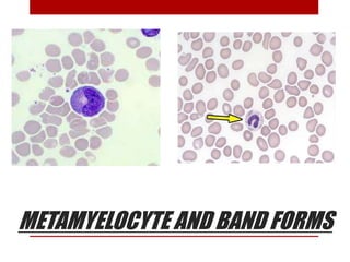 METAMYELOCYTE AND BAND FORMS
 