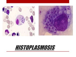 HISTOPLASMOSIS
 