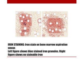 IRON STAINING: Iron stain on bone marrow aspiration
smear.
Left figure shows blue stained iron granules. Right
figure shows no stainable iron
 