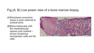 Fig.(A, B) Low power view of a bone marrow biopsy.
(A)Periosteal connective
tissue is seen external to
cortical bone.
(B)Bone trabeculae with
the intertrabecular
spaces (one marked –
arrow) containing
hemopoietic cells and fat
cells.
 