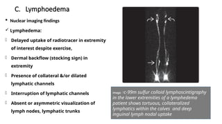 BONE MARROW IMAGING AND LYMPHOEDEMA.pptx