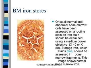 BM iron stores
Once all normal and
abnormal bone marrow
cells have been
assessed on a routine
stain an iron stain
should be examined,
using a medium power
objective (X 40 or X
50). Storage iron, which
stains blue, should be
assessed in bone
marrow fragments. This
image shows normal
bone
courtesy:anonymous marrow iron.


 