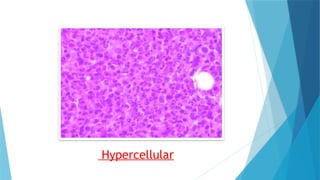Hypercellular Bone marrow smear preparation.......pptx