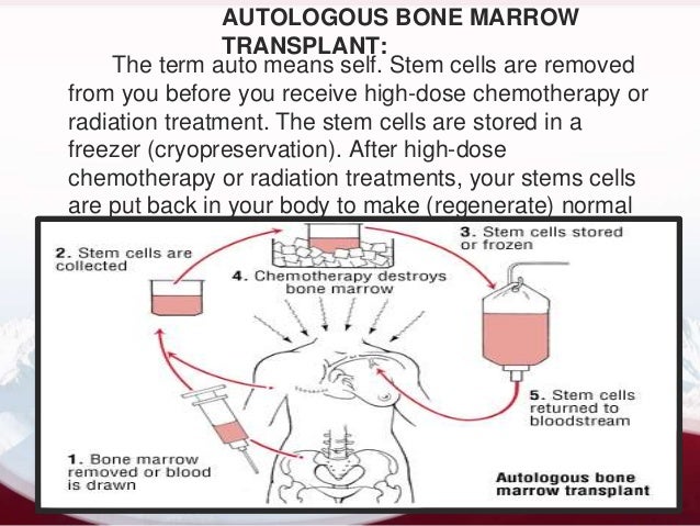 autologous stem cell transplant cure autologous stem cell transplant cure