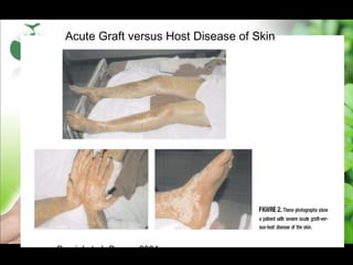 Couriel et al, Cancer 2004.
Acute Graft versus Host Disease of Skin
 