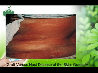 Graft Versus Host Disease of the Skin: Grade IV
 