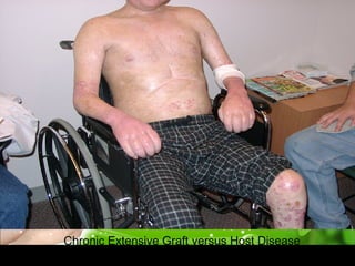 Chronic Extensive Graft versus Host Disease
 