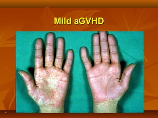 33
Mild aGVHDMild aGVHD
 