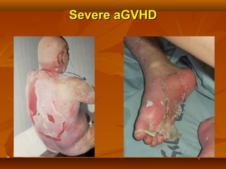34
Severe aGVHDSevere aGVHD
 