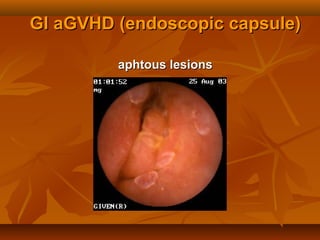 GI aGVHD (endoscopic capsule)GI aGVHD (endoscopic capsule)
aphtous lesionsaphtous lesions
 