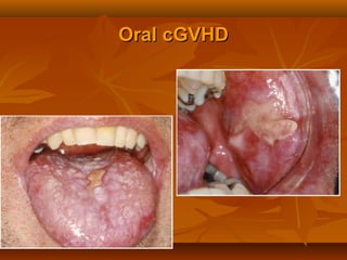 Oral cGVHDOral cGVHD
 
