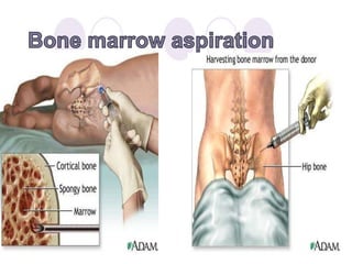 Bone marrow transplantation