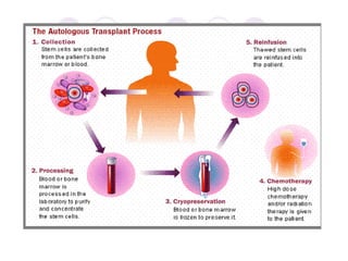 Bone marrow transplantation