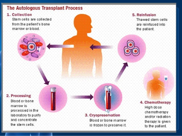 bone-marrow-transplantation-procedure