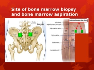 Site of bone marrow biopsy
and bone marrow aspiration
 
