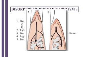 DISORDERS OF BONE METABOLISM :
1. Osteoporosis
a) Primary osteoporosis
b) Secondary osteoporosis
2. Rickets and osteomalacia
3. Bone resorption in the context of inflammatory disease
4. Paget's disease of bone (osteitis deformans)
5. Bone metastasis
 