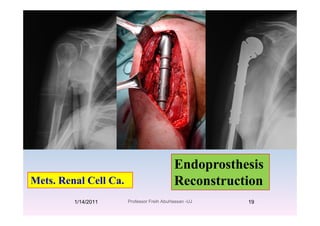 Endoprosthesis
Mets. Renal Cell Ca.
Endoprosthesis
Reconstruction
1/14/2011 19Professor Freih AbuHassan -UJ
 