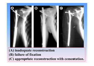 (A) inadequate reconstruction
(B) failure of fixation(B) failure of fixation
(C) appropriate reconstruction with cementation.1/14/2011 22Professor Freih AbuHassan -UJ
 