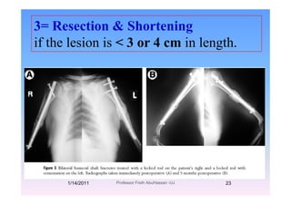 3= Resection & Shorteningg
if the lesion is < 3 or 4 cm in length.
1/14/2011 23Professor Freih AbuHassan -UJ
 