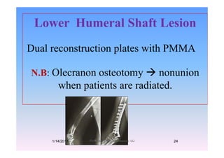 Lower Humeral Shaft LesionLower Humeral Shaft Lesion
Dual reconstruction plates with PMMA
N.B: Olecranon osteotomy nonunion
when patients are radiated.
1/14/2011 24Professor Freih AbuHassan -UJ
 