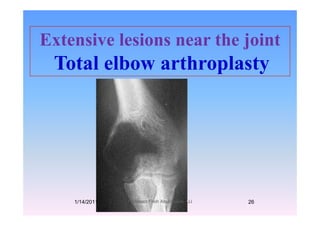 E t i l i th j i tExtensive lesions near the joint
Total elbow arthroplastyTotal elbow arthroplasty
1/14/2011 26Professor Freih AbuHassan -UJ
 