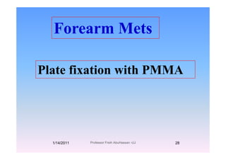 F M tForearm Mets
Plate fixation with PMMA
1/14/2011 28Professor Freih AbuHassan -UJ
 