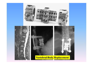 Vertebral Body Replacement1/14/2011 37Professor Freih AbuHassan -UJ
 