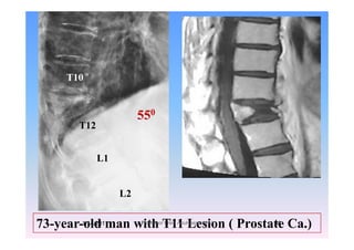 T10
T12
550
T12
L1
L2
73-year-old man with T11 Lesion ( Prostate Ca.)1/14/2011 38Professor Freih AbuHassan -UJ
 